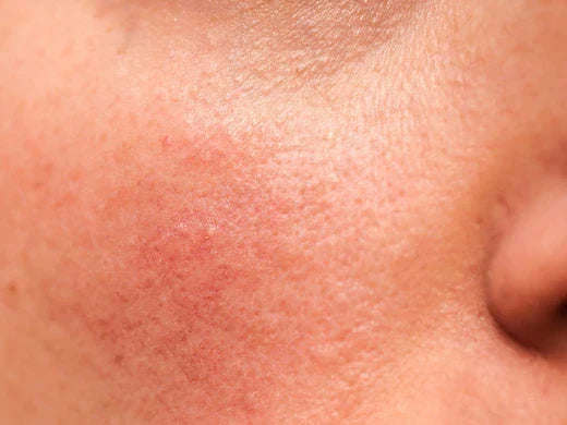 Cold weather and skin irritation