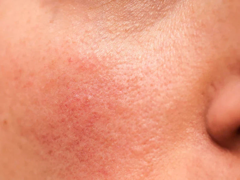 How To Treat Rosacea: Advice From Skincare Expert, Dr Anna Hemming