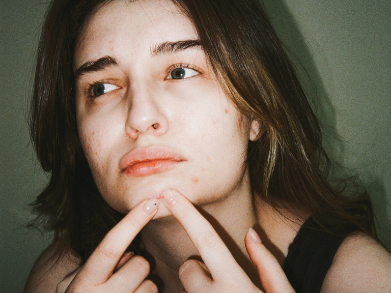Should you pop your pimples? | Top pimple popping tips from a skincare expert