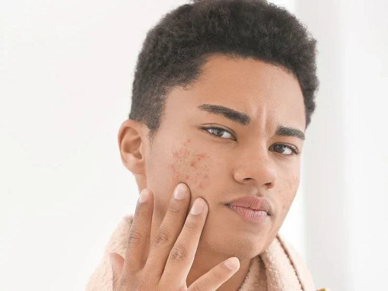 Understanding Acne with Dr Derek Phillips