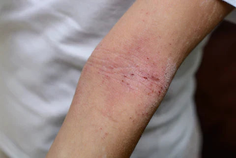 Everything you need to know about Eczema and how to look after Eczema prone skin