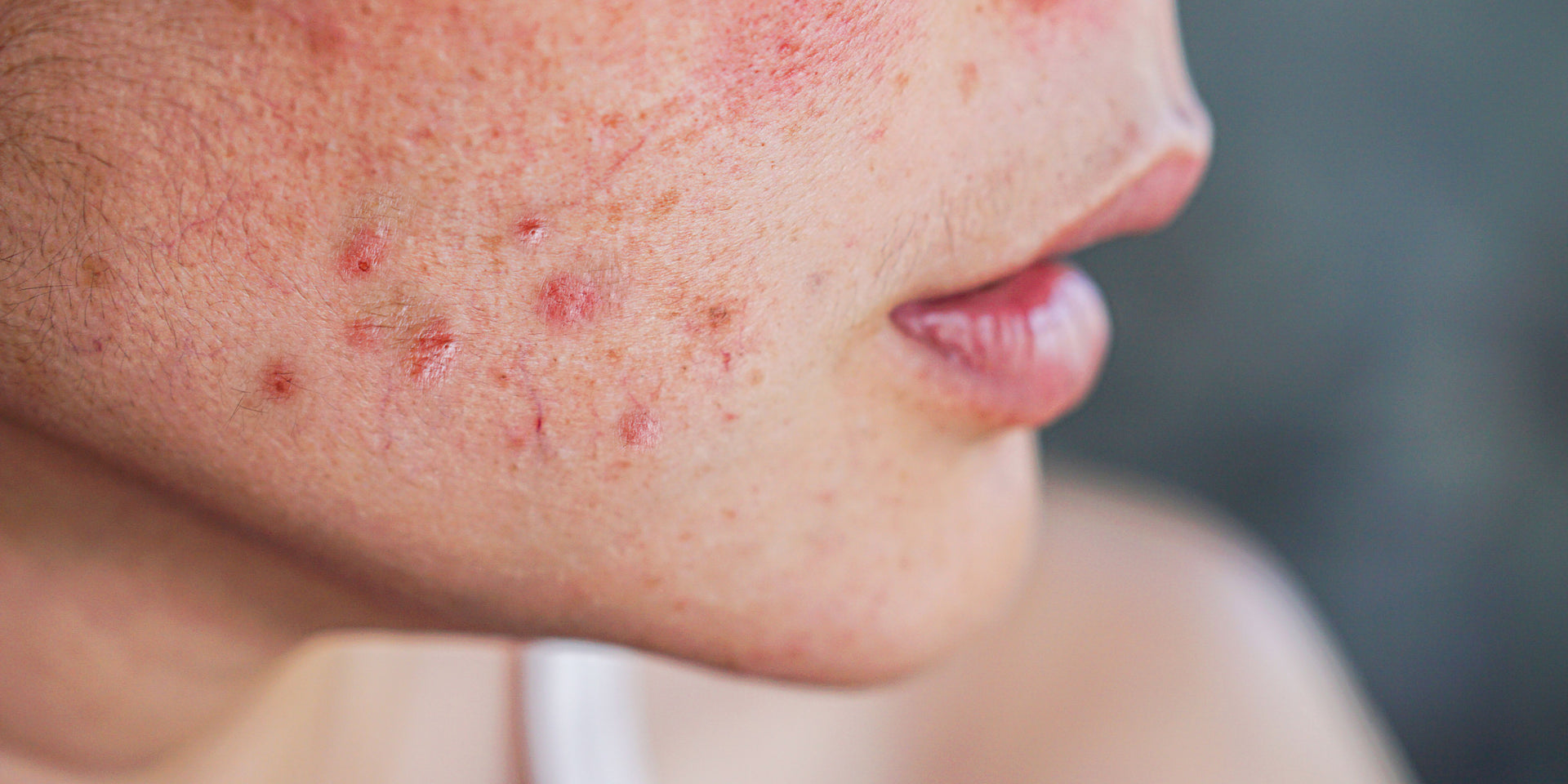 Understanding acne and blemish-prone skin