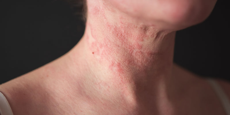 Dermatitis