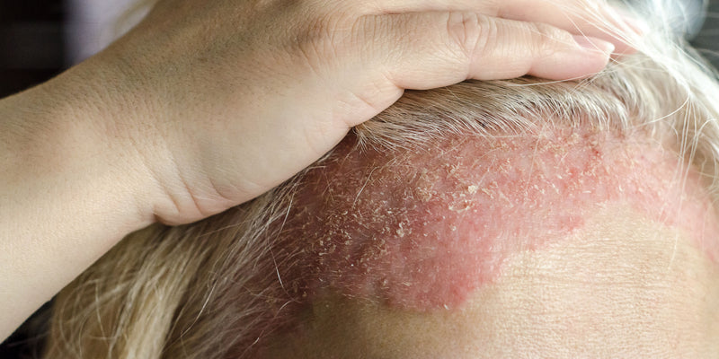Eczema