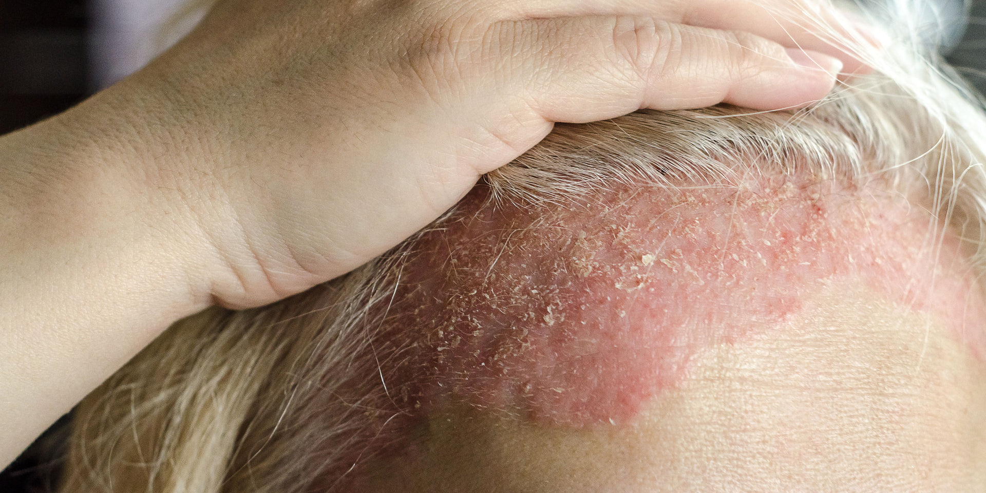 Understanding eczema
