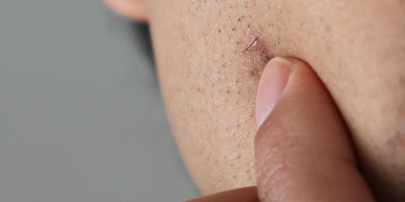 Folliculitis