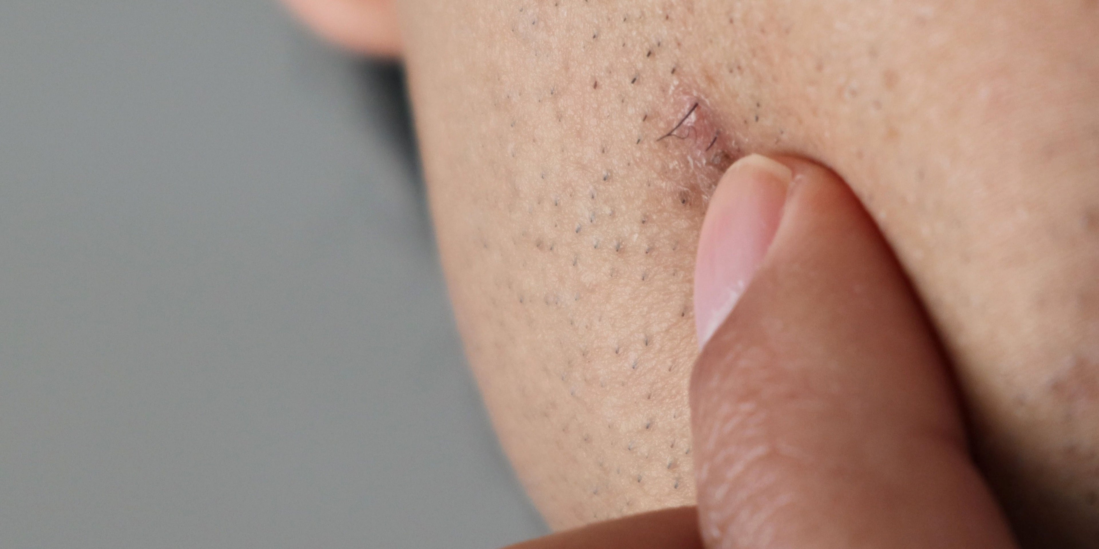 Folliculitis – Clinisoothe+ U.S