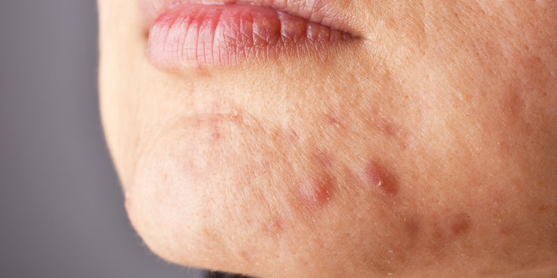 Hormonal Breakouts