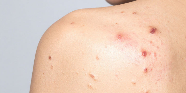 Understanding sensitive skin